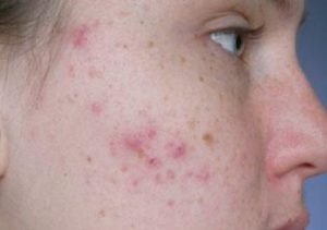 Acne Image